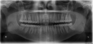 fogászati röntgen